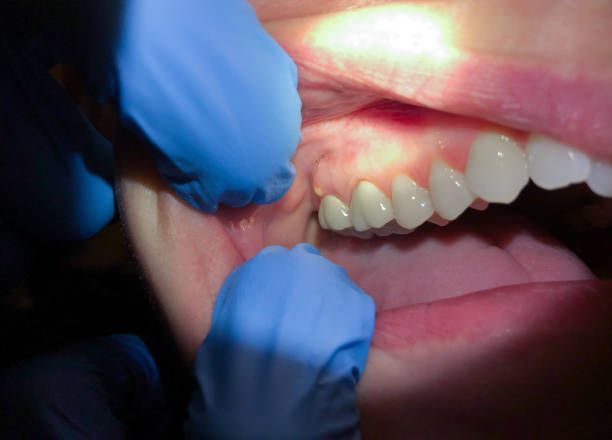 Best Emergency Dentist for Lost Fillings or Crowns in Hamburg, NJ